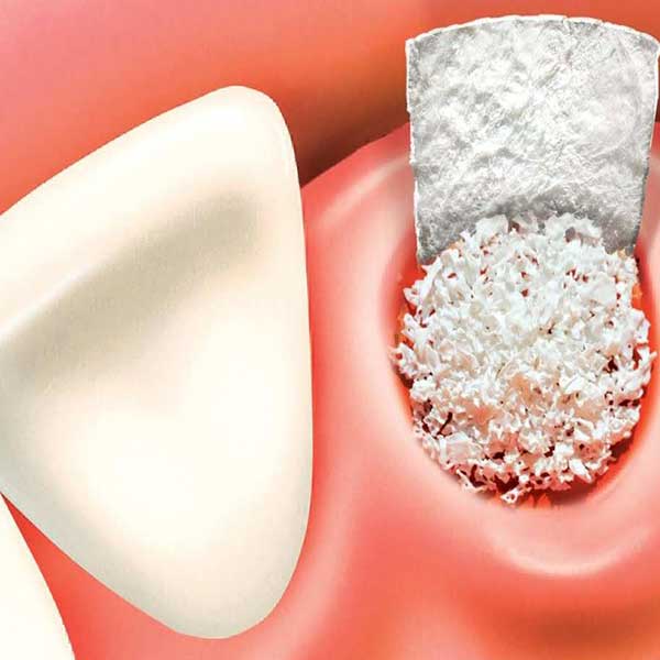 Single tooth implant